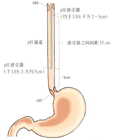 检测高位反流,pH感受器置于食管内的位置