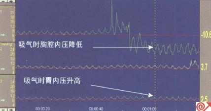 近端压力通道位于膈肌上方,图示吸气时压力下降