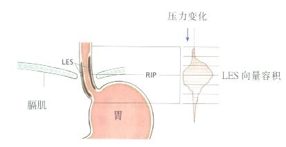 LES穿过膈肌示意图,LES压力轮廓用向量容积表示