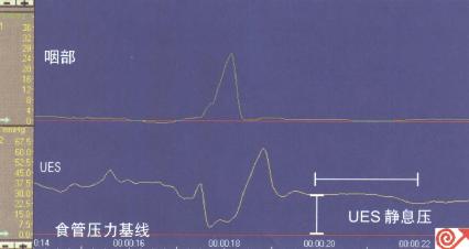 灌注式导管UES压力测定,显示了UES的静息压力