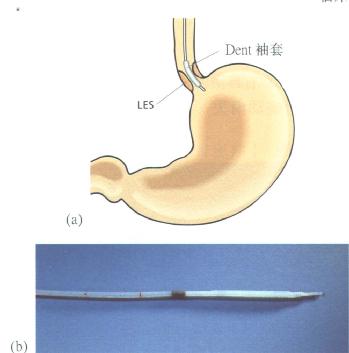 Dent袖套感受器,及进行LES测压时感受器的位置