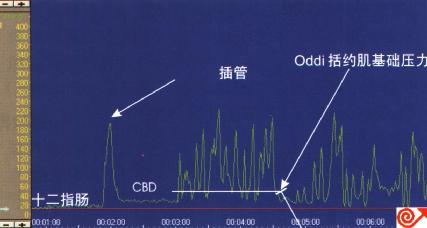 Oddi括约肌(SO)定点牵拉测压图