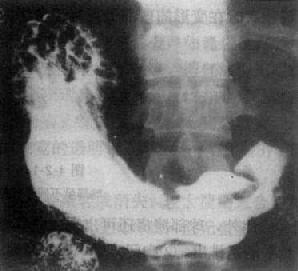 胃窦癌(溃疡型)