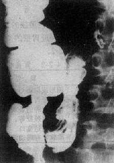 肠结核(增殖型)