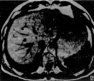 肝血管瘤(MRI)
