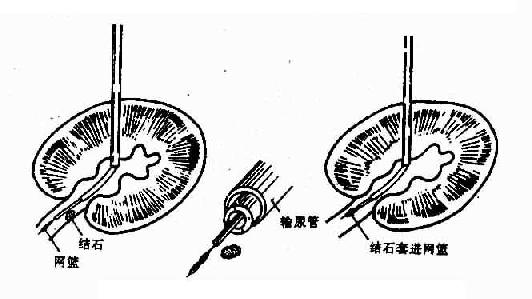 经皮肾盂造口术(套取结石)示意图